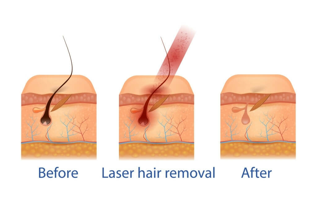 Lazer Epilasyon Nasıl İşler?